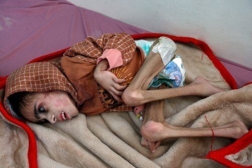 Menino iemenita com apenas 7 quilos recebe tratamento em um hospital de Sanaa, Iêmen, 29 de dezembro de 2020 [Mohammed Hamoud/Getty Images]