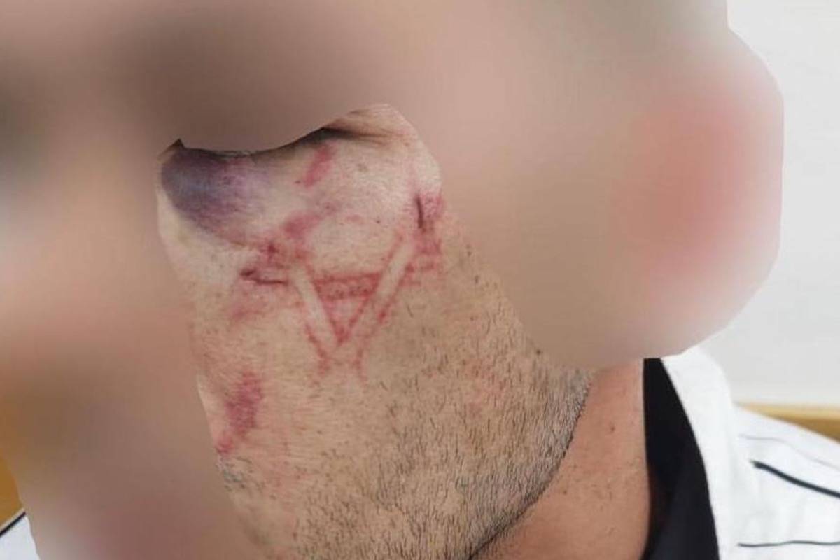 Rosto de Orwah Sheikh Ali (22), marcado com uma Estrela de Davi enquanto em custódia da polícia de Israel, em agosto de 2023 [Redes sociais]
