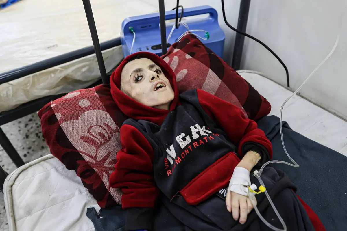 Menino palestino de dez anos com desnutrição grave, devido ao cerco israelense, recebe cuidados no Hospital Abu Yusuf al-Najjar, em Rafah, na Faixa de Gaza, em 28 de fevereiro de 2024 [Jehad Alshrafi/Agência Anadolu]
