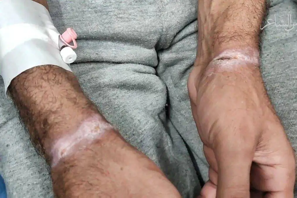 Marcas de tortura nas mãos de um cidadão palestino após ser sequestrado e posteriormente libertado pelas forças de Israel, no Hospital Abu Youssef Al-Najjar, em Rafah, no extremo sul de Gaza [Firas al-Shaer/Reprodução]
