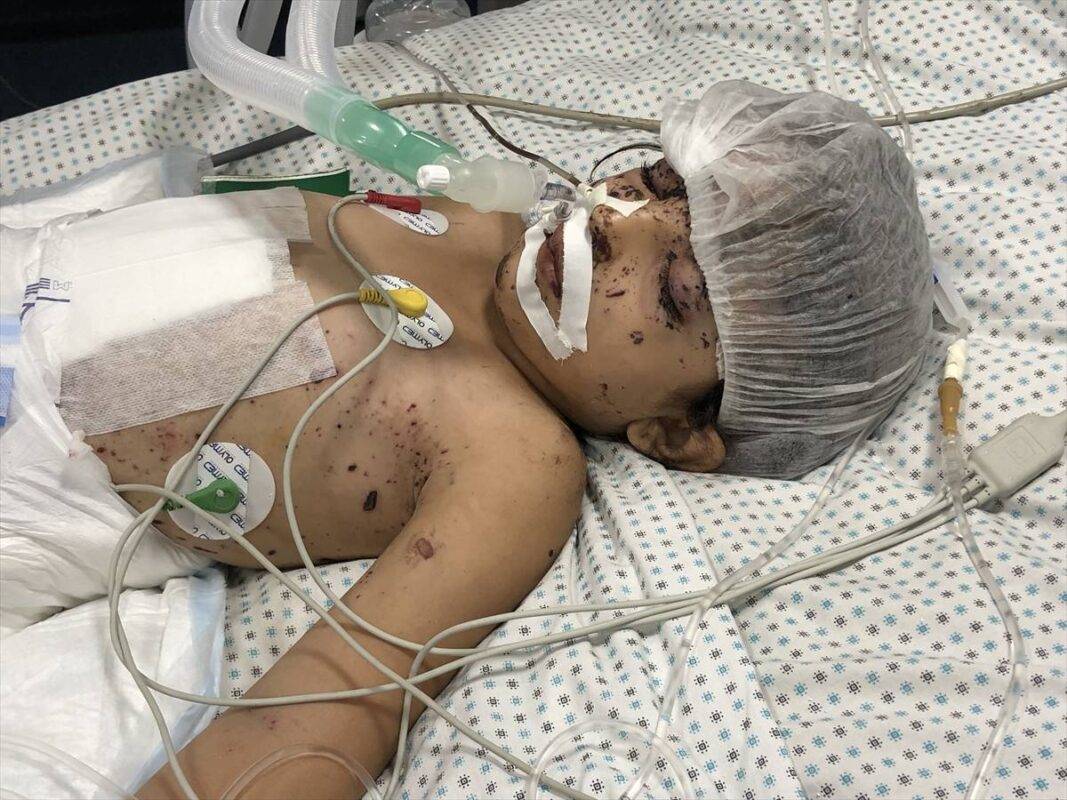 Wafaa Hamad, uma menina que perdeu todos os membros de sua família no ataque do exército israelense à sua casa, luta para sobreviver no Hospital Kemal Adwan na Cidade de Gaza. Wafaa, que perdeu a perna direita e a visão no ataque israelense, sofreu queimaduras e ferimentos no rosto e na maior parte do corpo, está sendo tratada com instalações limitadas. [Khalil Ramzi Alkhalut/Agência Anadolu]