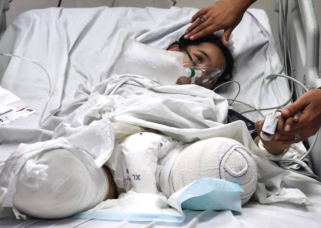 Razan Arafat Barbah, menina palestina de 14 anos que perdeu ambas as pernas para um bombardeio israelense a sua casa na cidade de Rafah, no sul de Gaza, em tratamento no Hospital Nasser de Khan Yunis, Gaza, em 1º de outubro de 2024 [Hani Alshaer/Anadolu via Getty Images]
