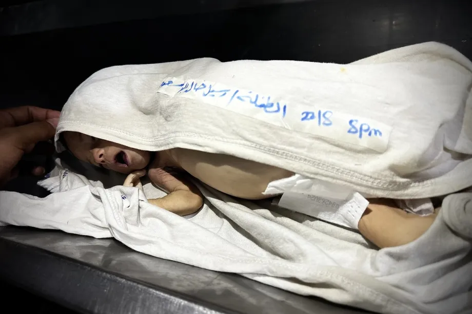 Criança palestina sofre de desnutrição severa em tenda de refugiados na Cidade
de Gaza, em 20 de agosto de 2025 [Abdalhkem Abu Riash/Agência Anadolu]